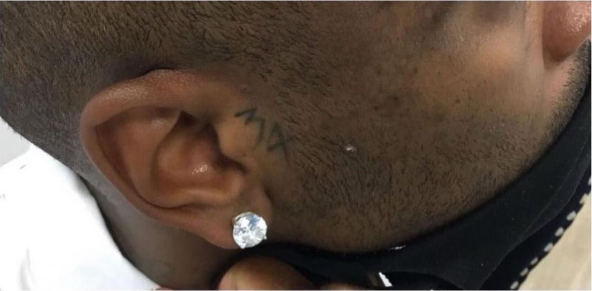 Before: Tattoo removal, face