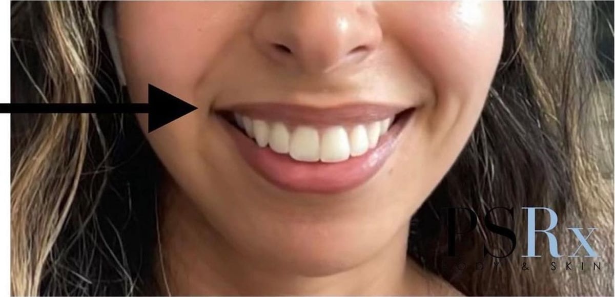 After: Neurotoxin, lips