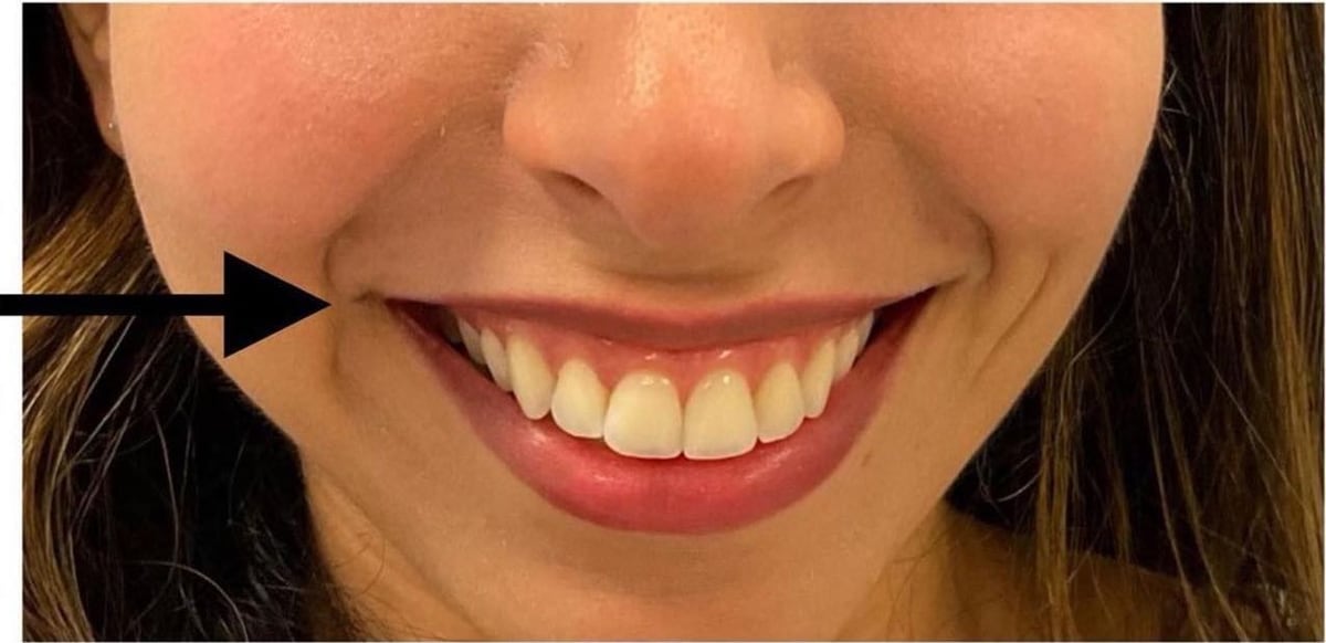 Before: Neurotoxin, lips