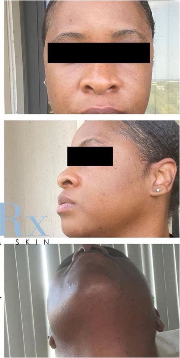 After: Dark spots, face