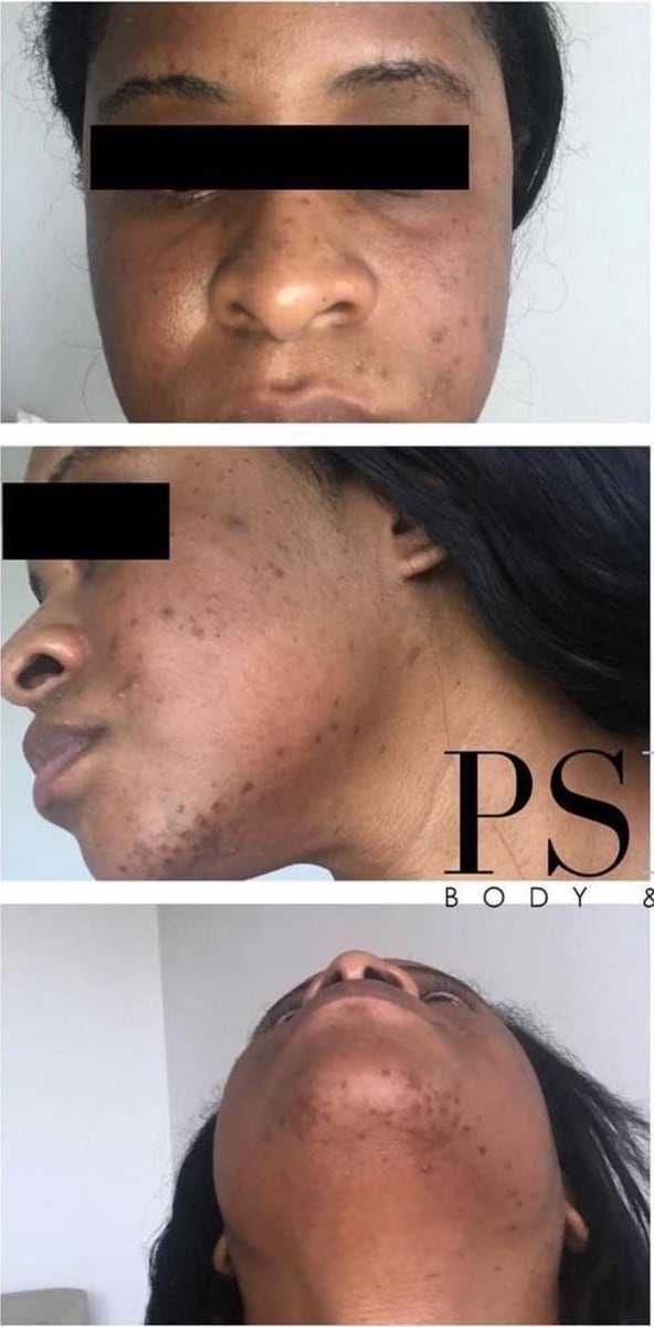 Before: Dark spots, face