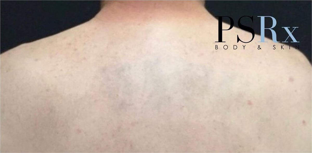 After: Tattoo removal, back