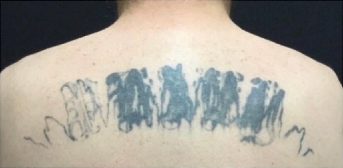 Before: Tattoo removal, back