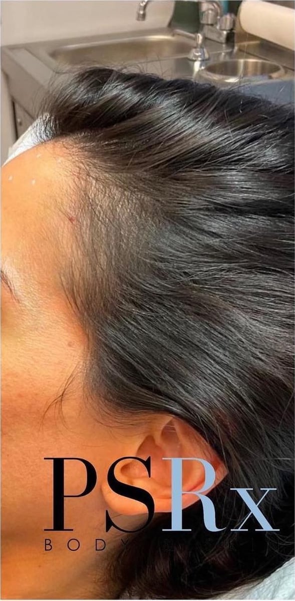 After: PRP hair restoration, scalp