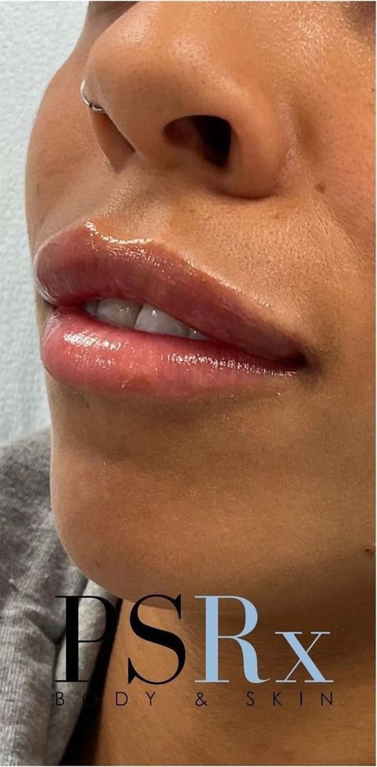 After: Fuller, defined lips