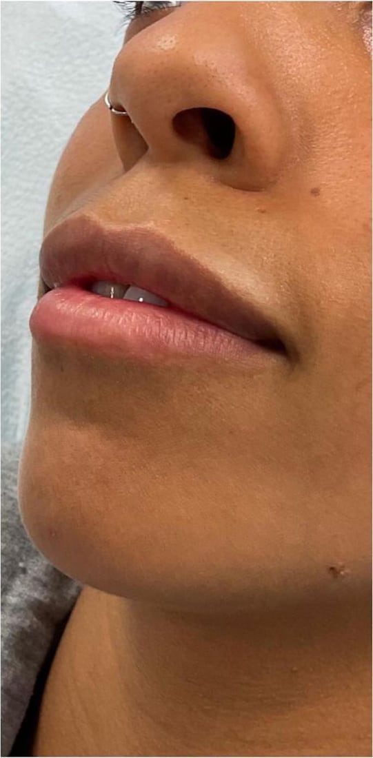 Before: Fuller, defined lips