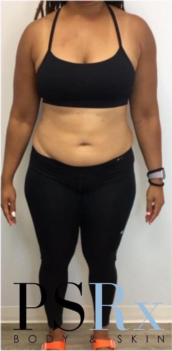 Before: Body contouring, abdomen