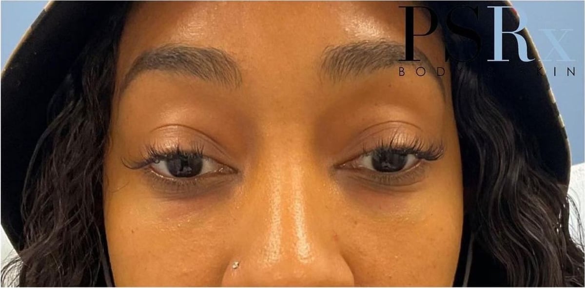 After: Filler, under the eyes
