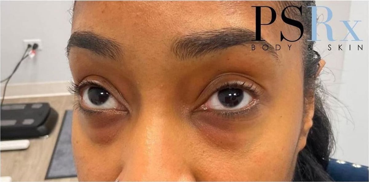 Before: Filler, under the eyes