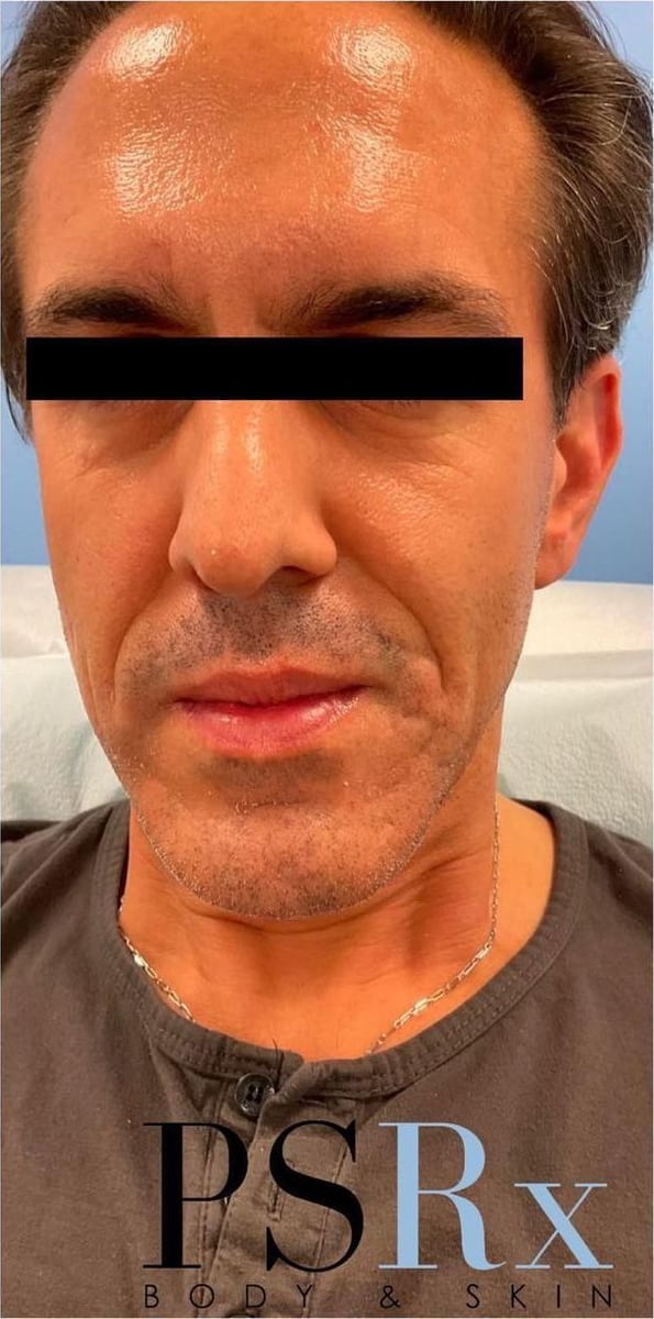 After: Neurotoxin, face