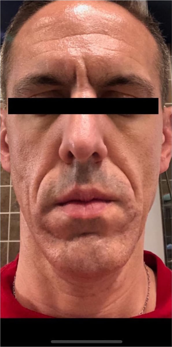Before: Neurotoxin, face