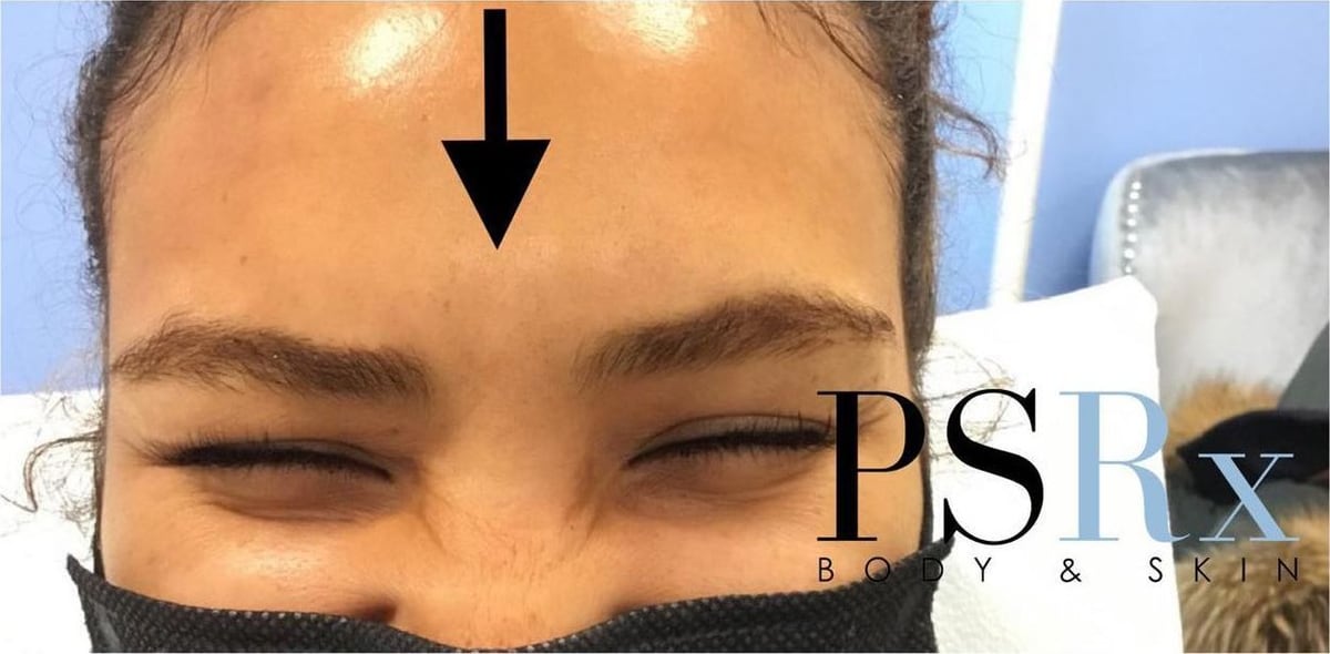 After: Neurotoxin, forehead
