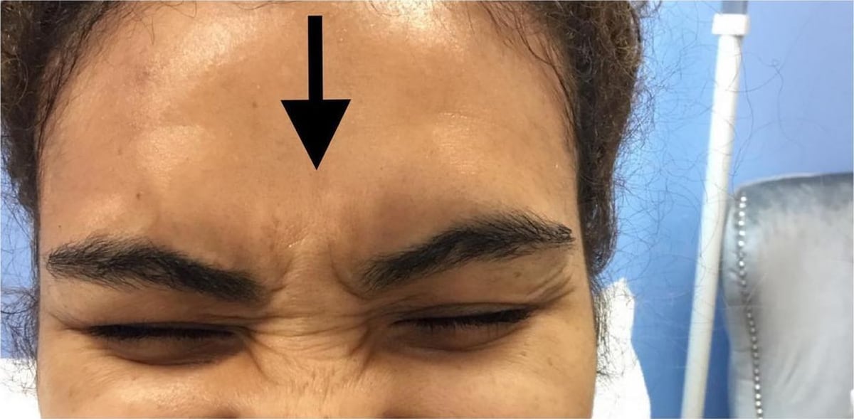Before: Neurotoxin, forehead