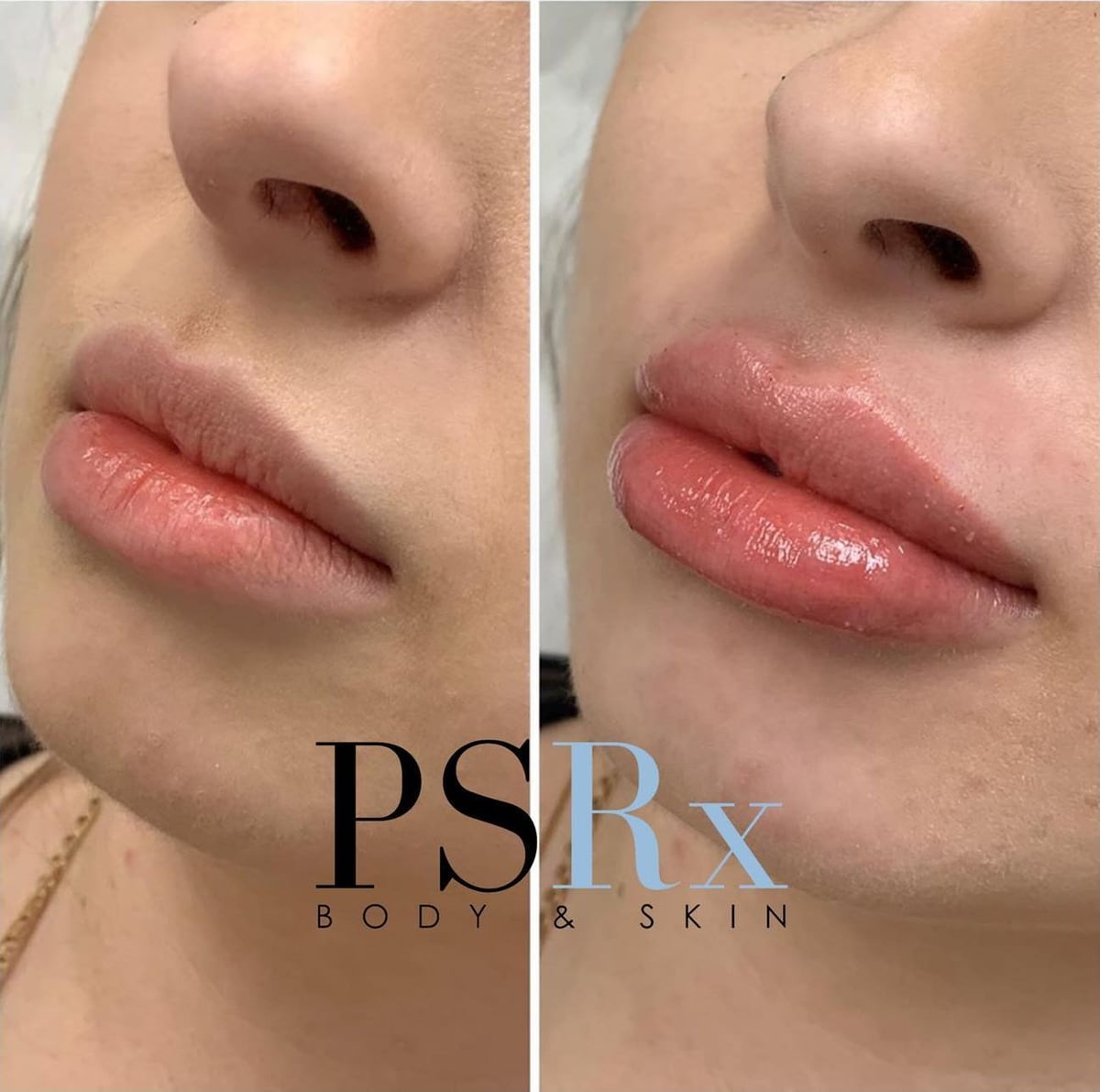 Before and after: Filler, lips