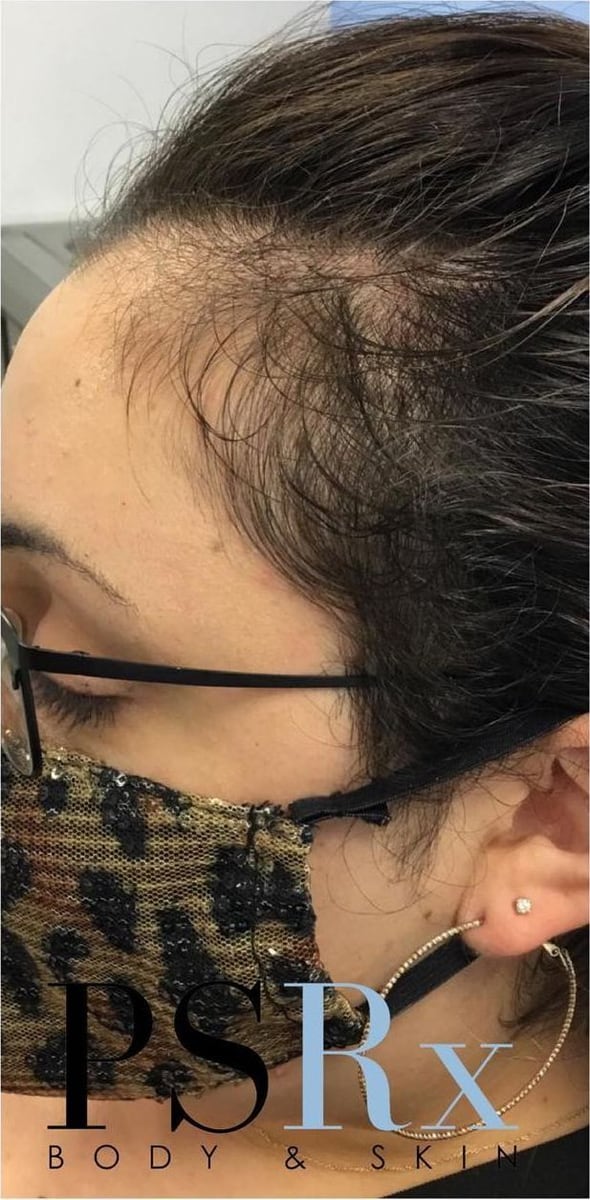 After: PRP hair restoration, scalp