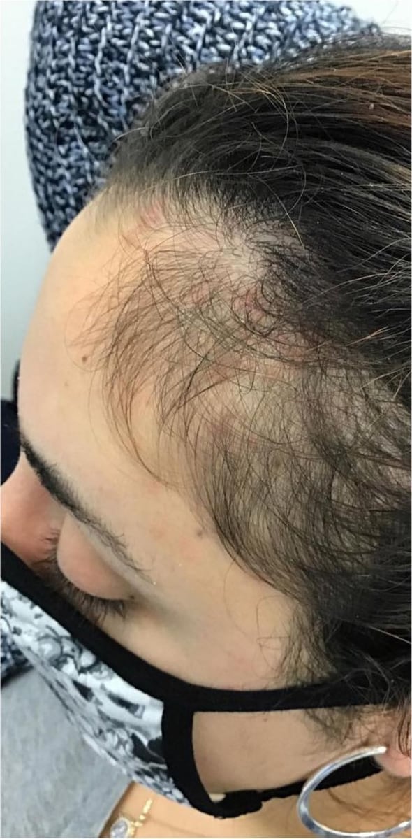 Before: PRP hair restoration, scalp