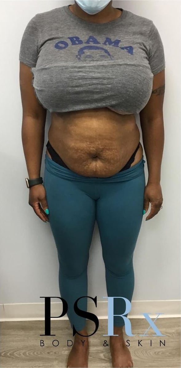 After: Body contouring, abdomen