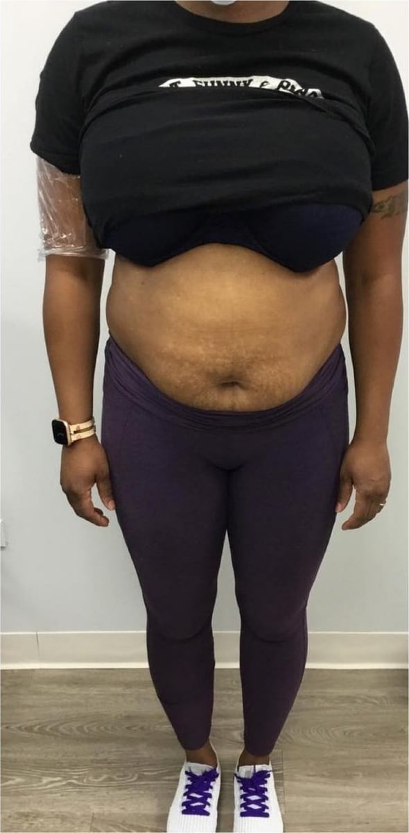 Before: Body contouring, abdomen