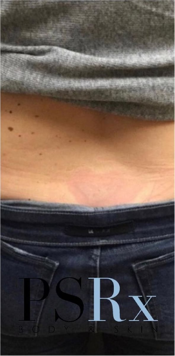 After: Tattoo removal, back