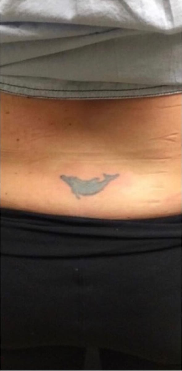 Before: Tattoo removal, back