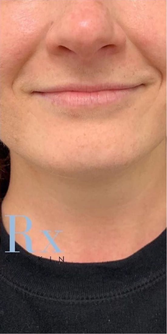 After: Fullness under the chin