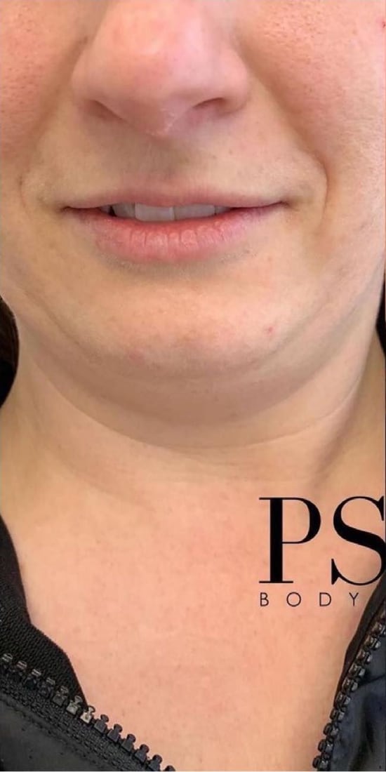 Before: Fullness under the chin