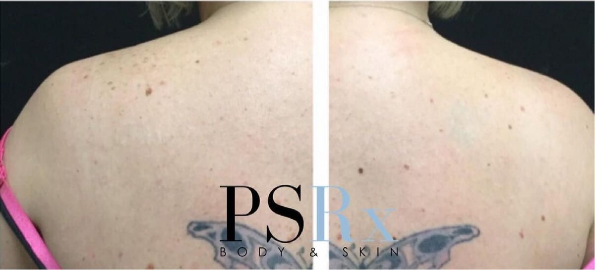 After: Tattoo removal, back