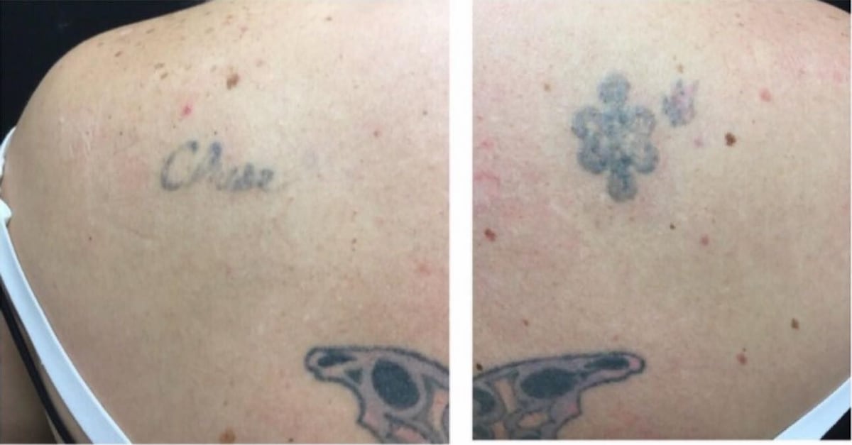 Before: Tattoo removal, back