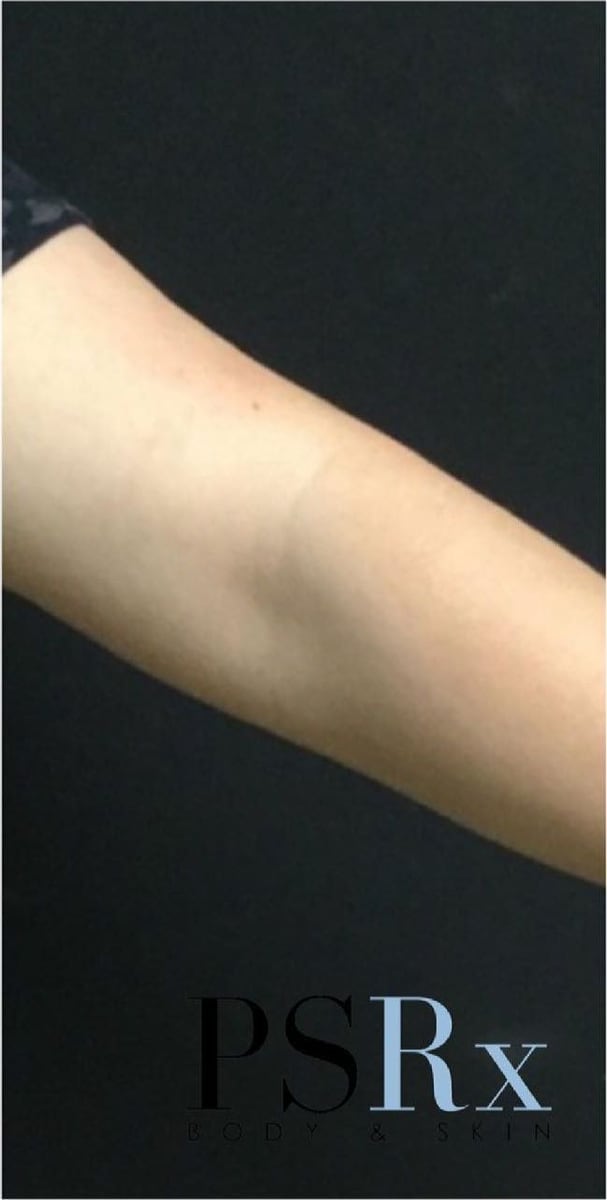 After: Tattoo removal, arm