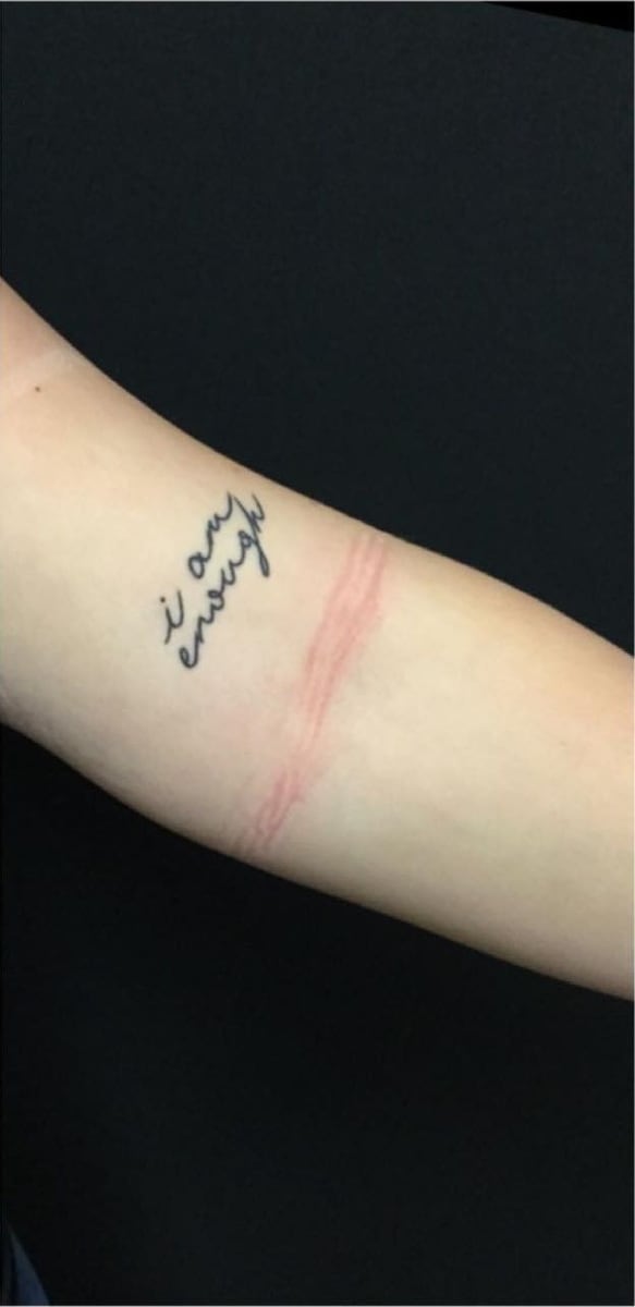 Before: Tattoo removal, arm