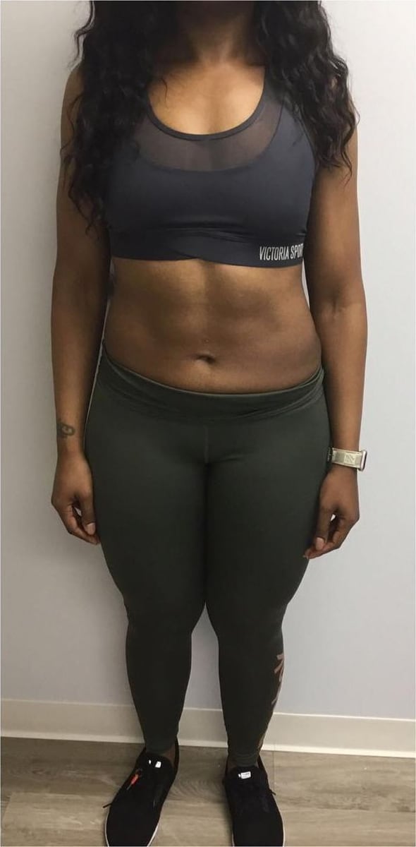 After: Body contouring, abdomen