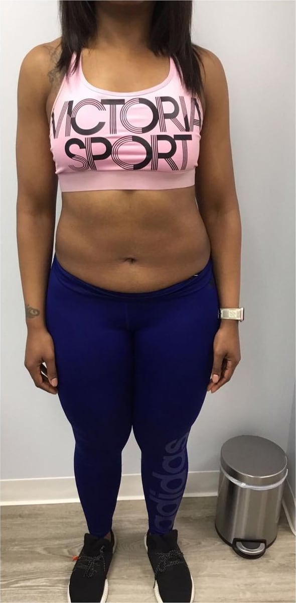 Before: Body contouring, abdomen