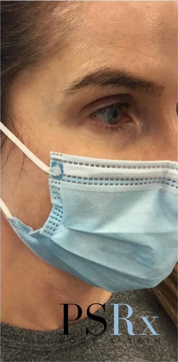 After: Neurotoxin, face