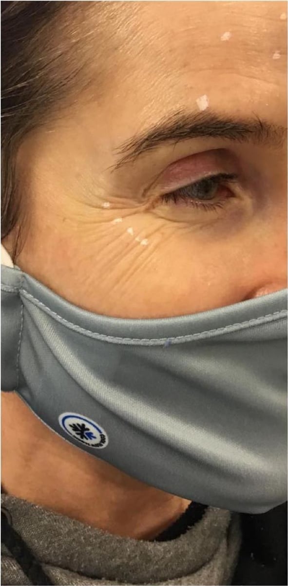 Before: Neurotoxin, face