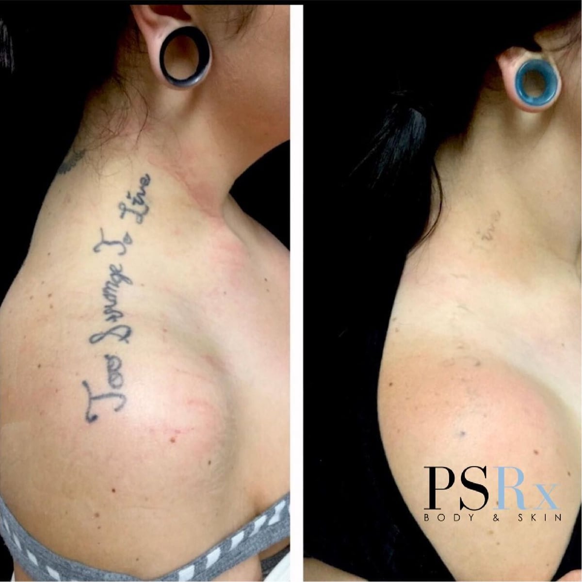 Before and after: Tattoo removal, neck