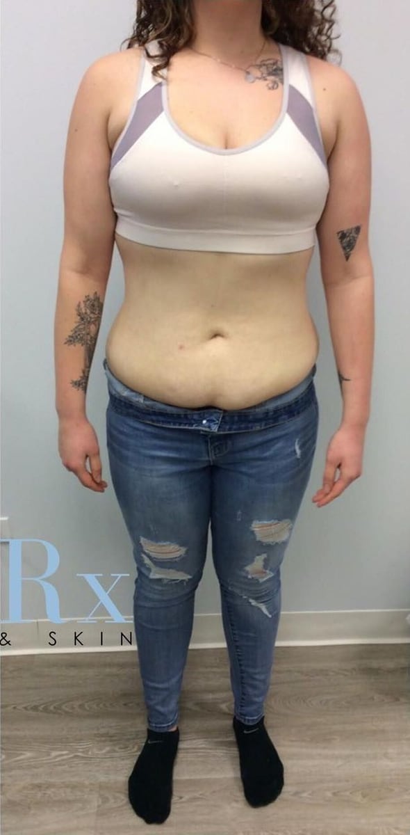 After: Body contouring, abdomen