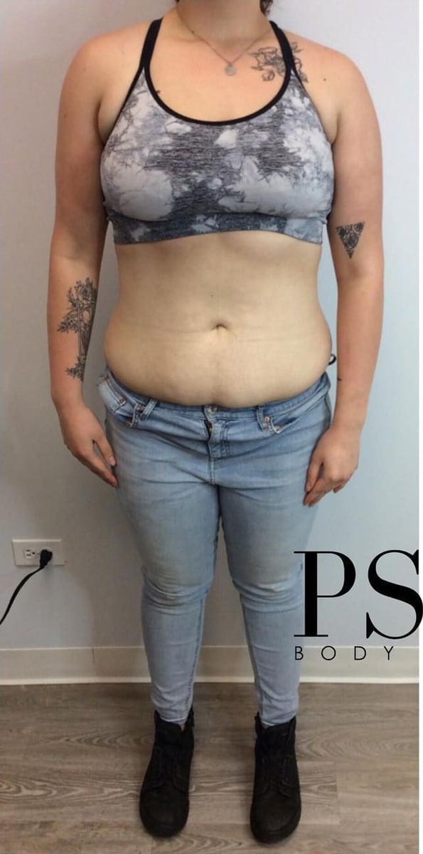 Before: Body contouring, abdomen