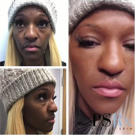 Before and after: Filler, under the eyes