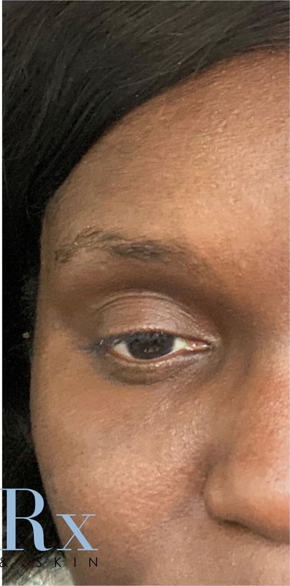 After: Filler, under the eyes