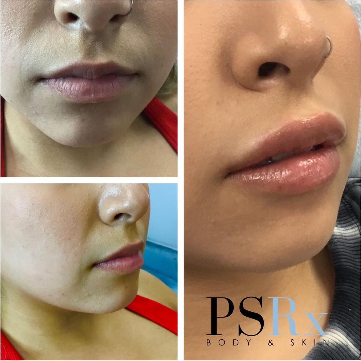 Before and after: Filler, lips