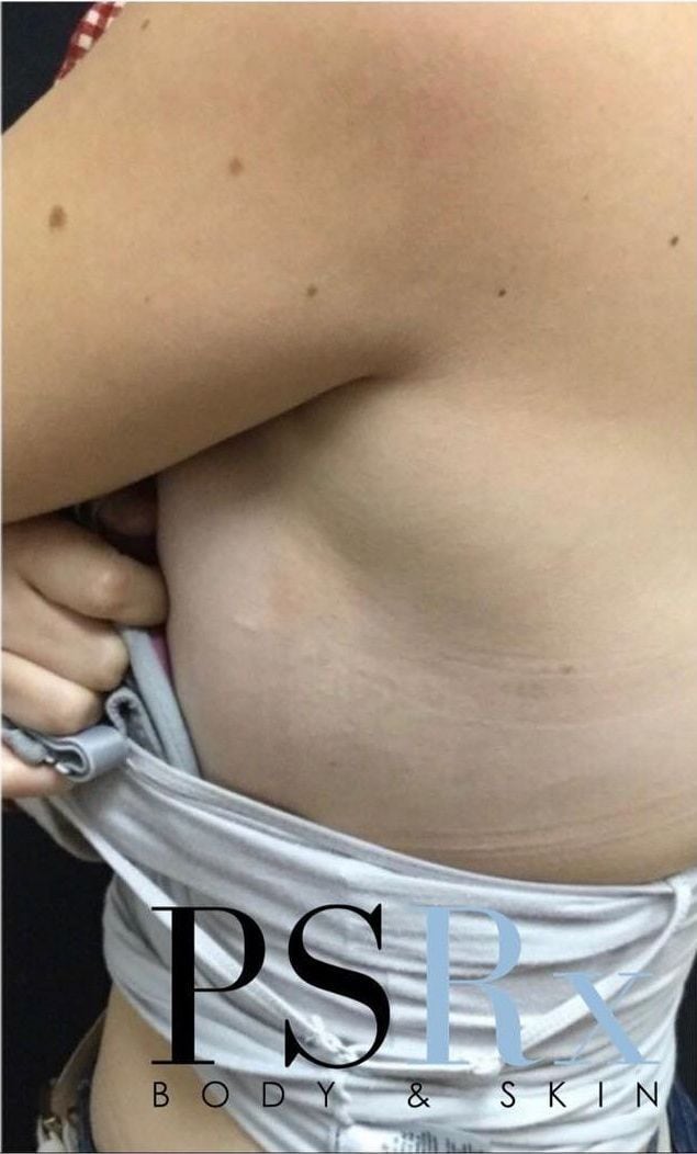 After: Tattoo removal, abdomen