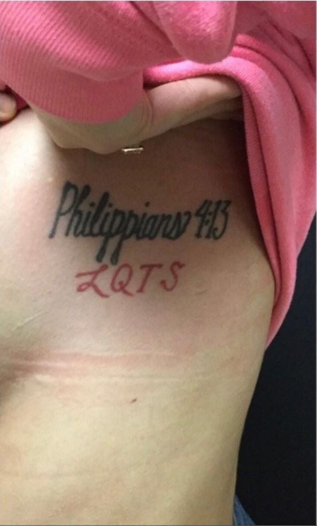 Before: Tattoo removal, abdomen