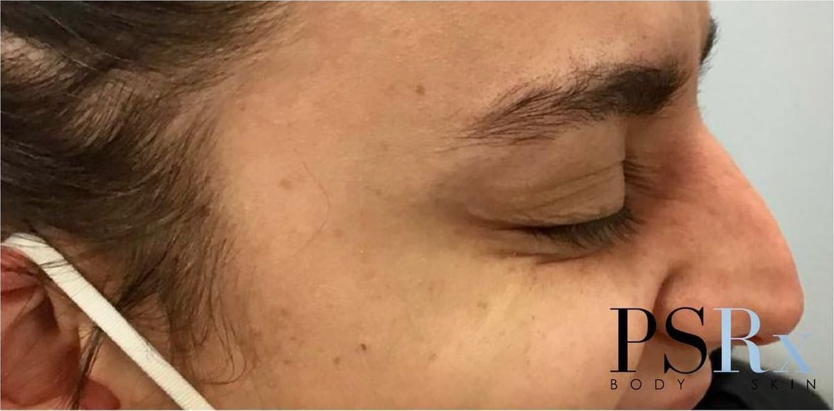 After: Neurotoxin, face