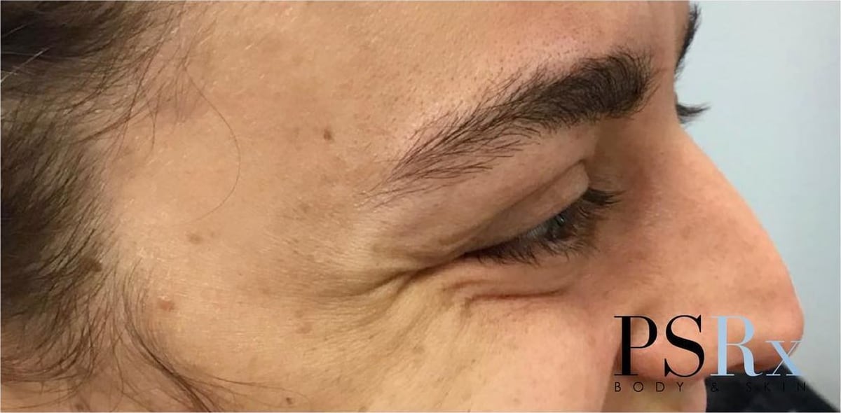 Before: Neurotoxin, face