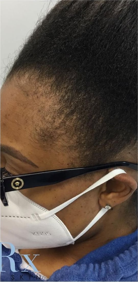 After: Thinning at the temples