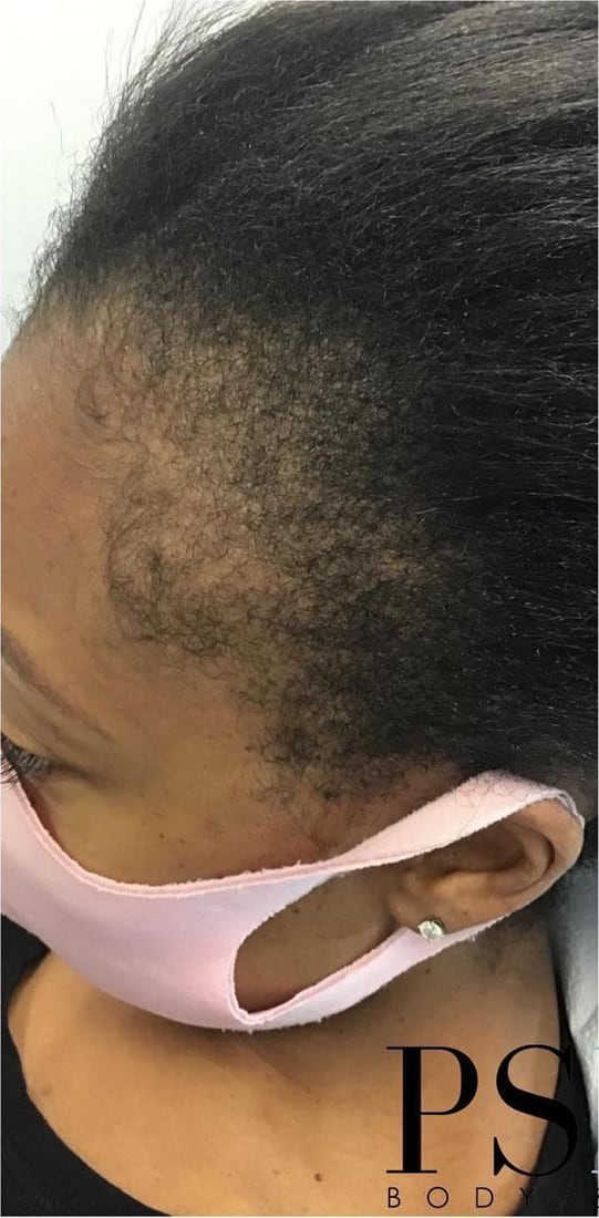 Before: Thinning at the temples