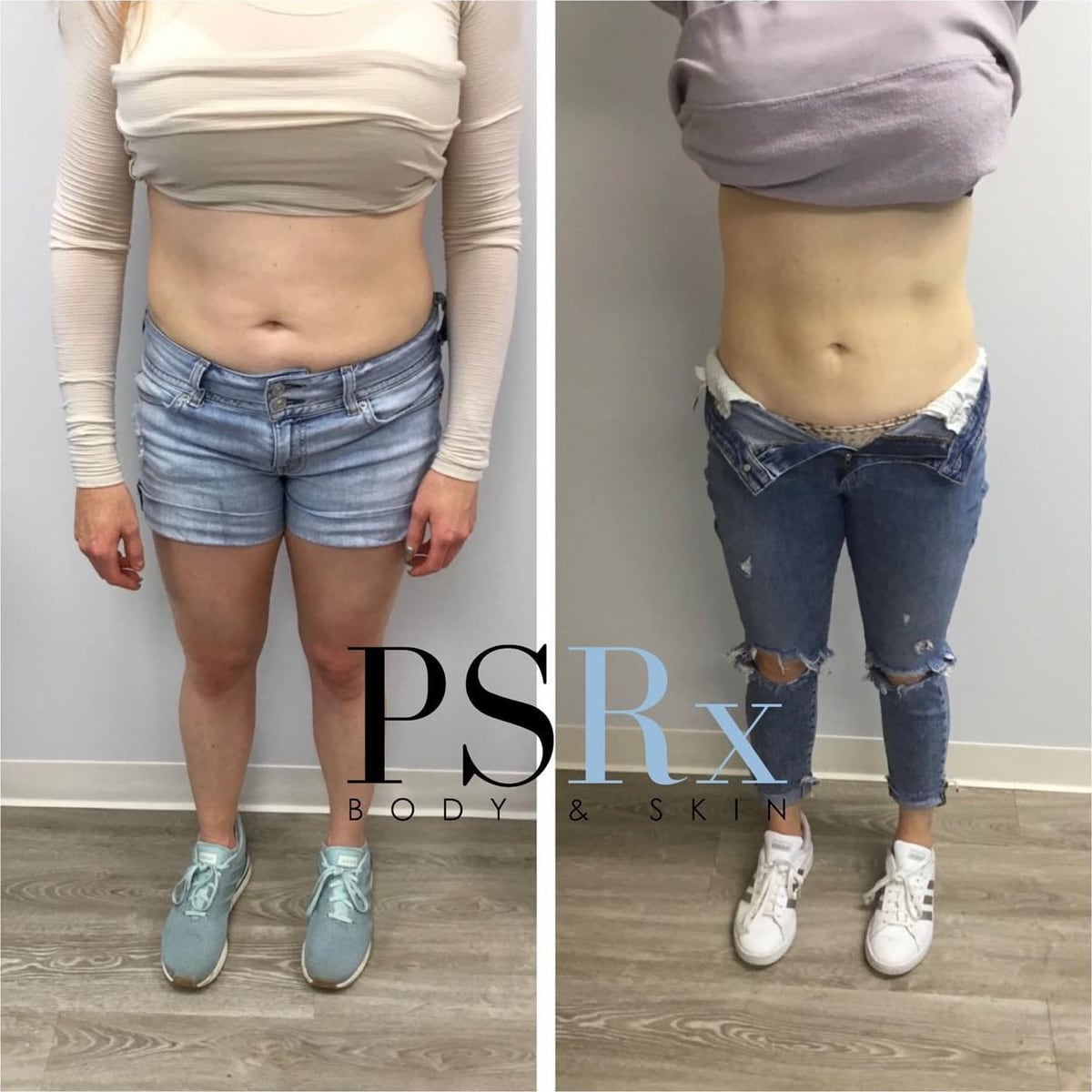 Before and after: Body contouring, abdomen