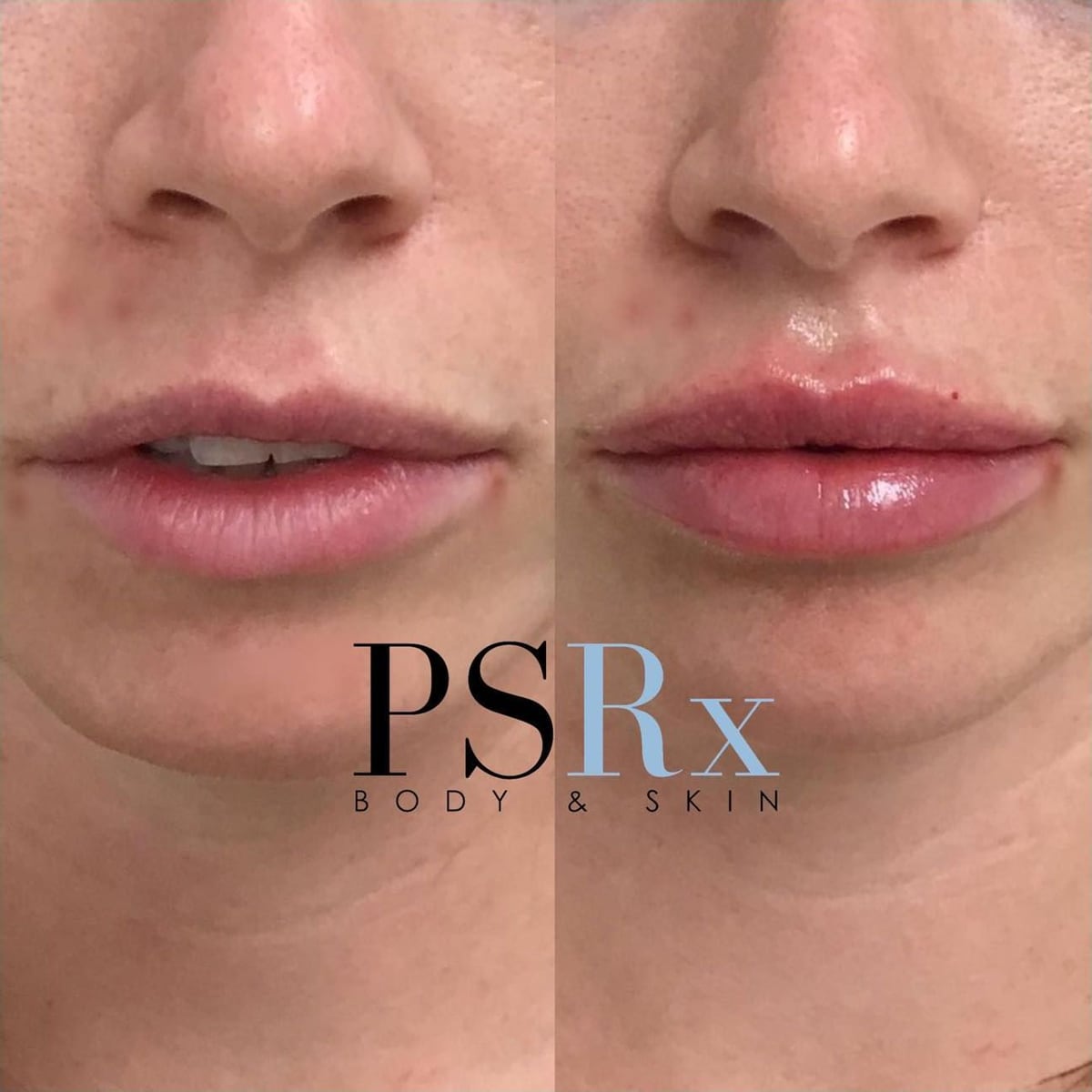 Before and after: Filler, lips