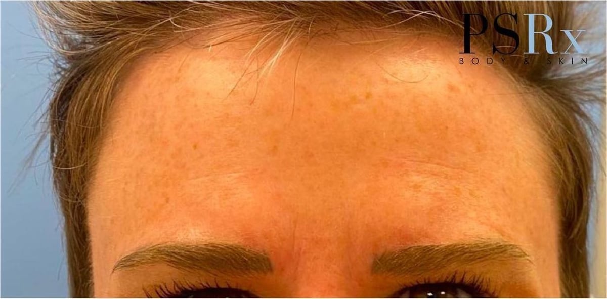 After: Neurotoxin, forehead