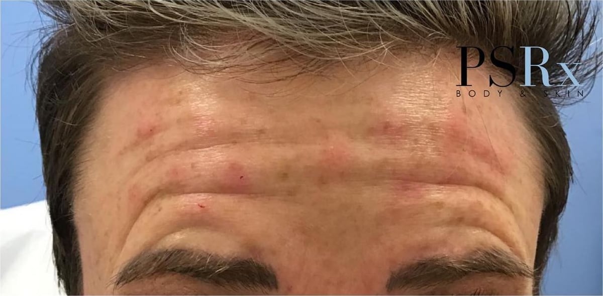 Before: Neurotoxin, forehead